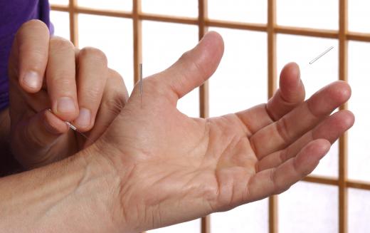 Acupuncture makes use of pressure points in order to provide pain relief and healing.