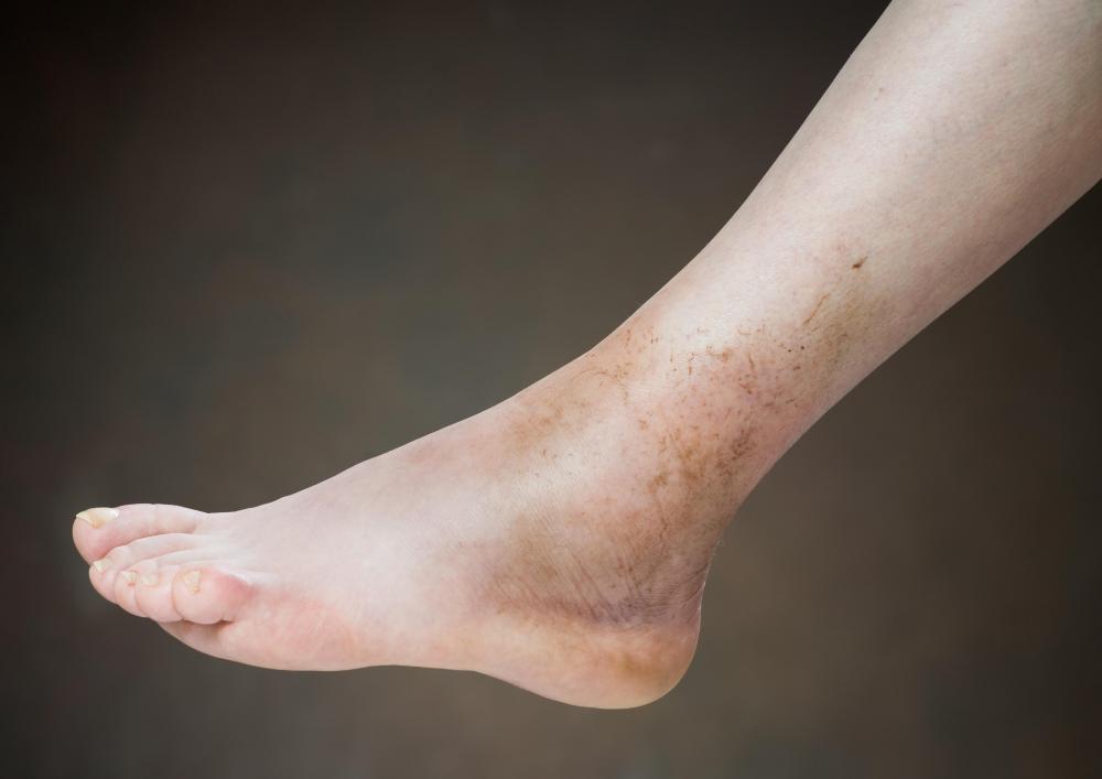 In Football, what is Injured Reserve? (with pictures)