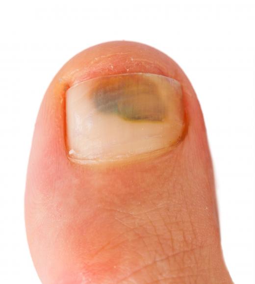 Wearing too small hiking boots can lead to a bruised toe.